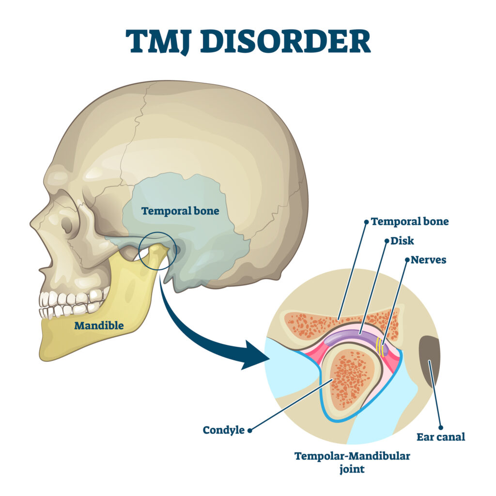 TMJ disorder vector illustration. Labeled jaw condition educational scheme. Diagram with joint clicking and pain anatomical structure and explanation. 